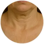 Detailní AI vizualizace vrásek a linií na krku vytvořená pro online program Facelift Yoga Experience od certifikované lektorky Martiny Bajerové. Slouží k ilustraci zaměření technik pro tuto partii.